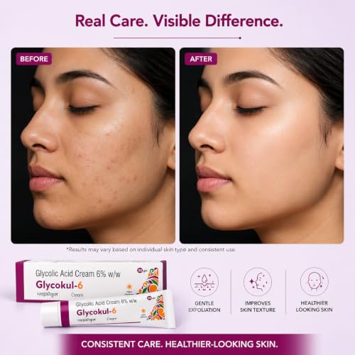 Image of Glyco 6 Glycolic Acid Face Cream 6% w /w | Exfoliating Cream for Acne, Pimples & Dark Spots | Unclogs Pores & Improves Skin Texture | Suitable for Dry & Acne-Prone Skin | 30g (Pack of 1)