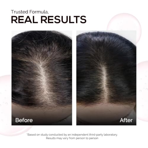 Image of KORE Anti-Hair Fall Multi-Peptide Shampoo | Clinically Crafted for Up to 95% Hair Fall Reduction | Powered by Kore Dense Technology | Copper Peptide, Leucine & Tyrosine | For All Hair Types, 5 ml, Sachet