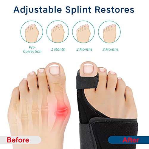 Pintle Bunion Corrector For Women And Men, Big Toe Separator Pain Relief, Big Toe Straightener With Splint, Bunion Corrector Pad With Adjustable Strap, Hallux Valgus Brace For Day/Night Support #TOP4