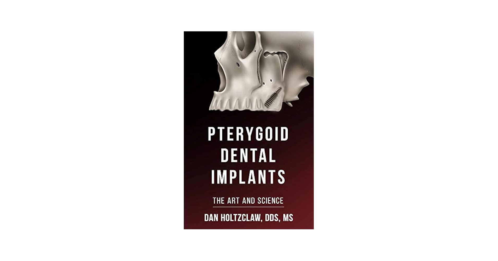 Pterygoid Implants: The Art and Science: Dan Holtzclaw