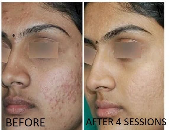 TCAPlatinumDerm 95% Peel (0.3oz/10ml) medium depth chemical peel ideal for Dilutions and spot application on scars with CROSS Technique, for Aestheticians and DIY skincare enthusiasts - Image 3