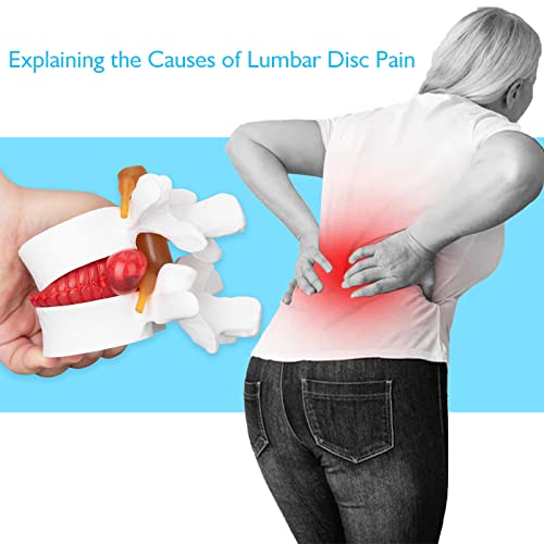 Image of ANNWAN Disc Herniation Model - Human Lumbar Disc Herniation Spine Model Vertebrae Disc Model for Teaching and Studying