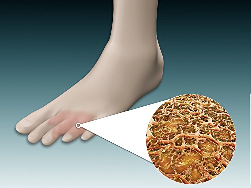 Posterazzi Anatomy of foot fungus with microscopic close-up Poster Print,