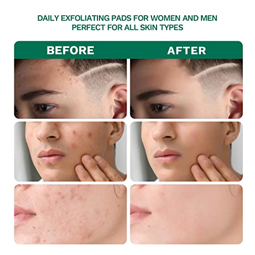 2% Salicylic Acid Acne Pads,Acne Treatment Pads, Face Cleansing Pads Witch Hazel Pads For Breakouts, Blackheads Prevention, Acne & Blemishes Clear, Facial Peel Resurfacing & Exfoliating Face Wash Wipes, 80 Count #TOP3