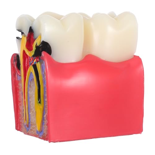 BESTYASH Modèle Pédagogique de Caries Dentaires à 6x Grossissement en Résine, Outil Typodont D'anatomie Comparée Dents Saines Vs Cariées, pour Enseignement en École et Cabinet