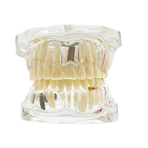 Transparent Disease Teeth Model,Transparent Dental Implant Teeth Model Dentist Standard Disease Removable Tooth Pathological Teaching Model
