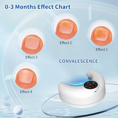 Micosi Unghie Per Multiple Unghie Dei Piedi & Delle Mani Con Luce Infrarossa 910 Nm + Luce Blu 470Nm, Dispositivo Antimicotico Unghie Ricaricabile Adatto Per Varie Occasioni. - 4