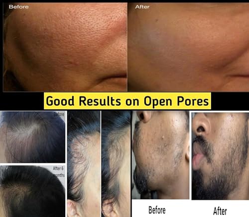 Image of Derma Roller 0.5mm With 540 Titanium Needles | Suitable for Anti-aging | Open Pores | Acne Scars | Hair & Beard Growth | Skin Care | Women and Men