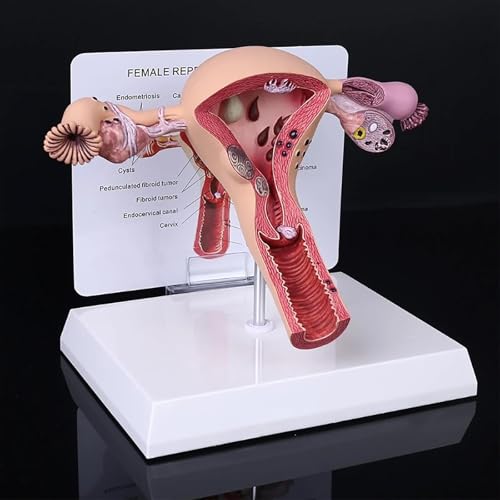YZHYYDS Modelo de Útero y Ovario Patológico, Modelo del Órgano Reproductor Femenino, Modelo Anatómico de Útero Humano con Tarjeta Educativa y Base, para la Enseñanza y el Aprendizaje.