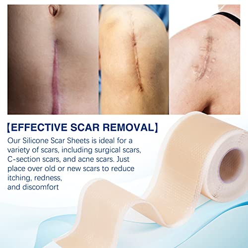 Silicone Scar Sheets (1.6”X 130”, 3.3M), Professional Silicone Scar Tape, Silicone Scar Strips, Reusable Scar Removal Sheets For Surgical Scars, C-Section, Surgery, Burn, Keloid, Acne #TOP3