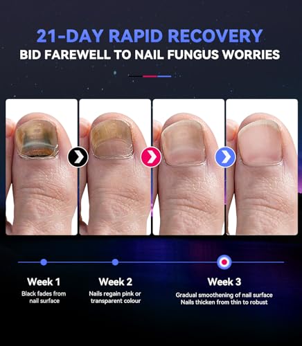 2025 Innovation 5.0 TOP Nagelpilz Laser mit Zeitmessgerät 【Industrie Nr.1 Laser-Wirkung】Nagelpilz Lasergerät 【Stärkste Wirkung-Schnell Wirkende】 Verbesserte Hause