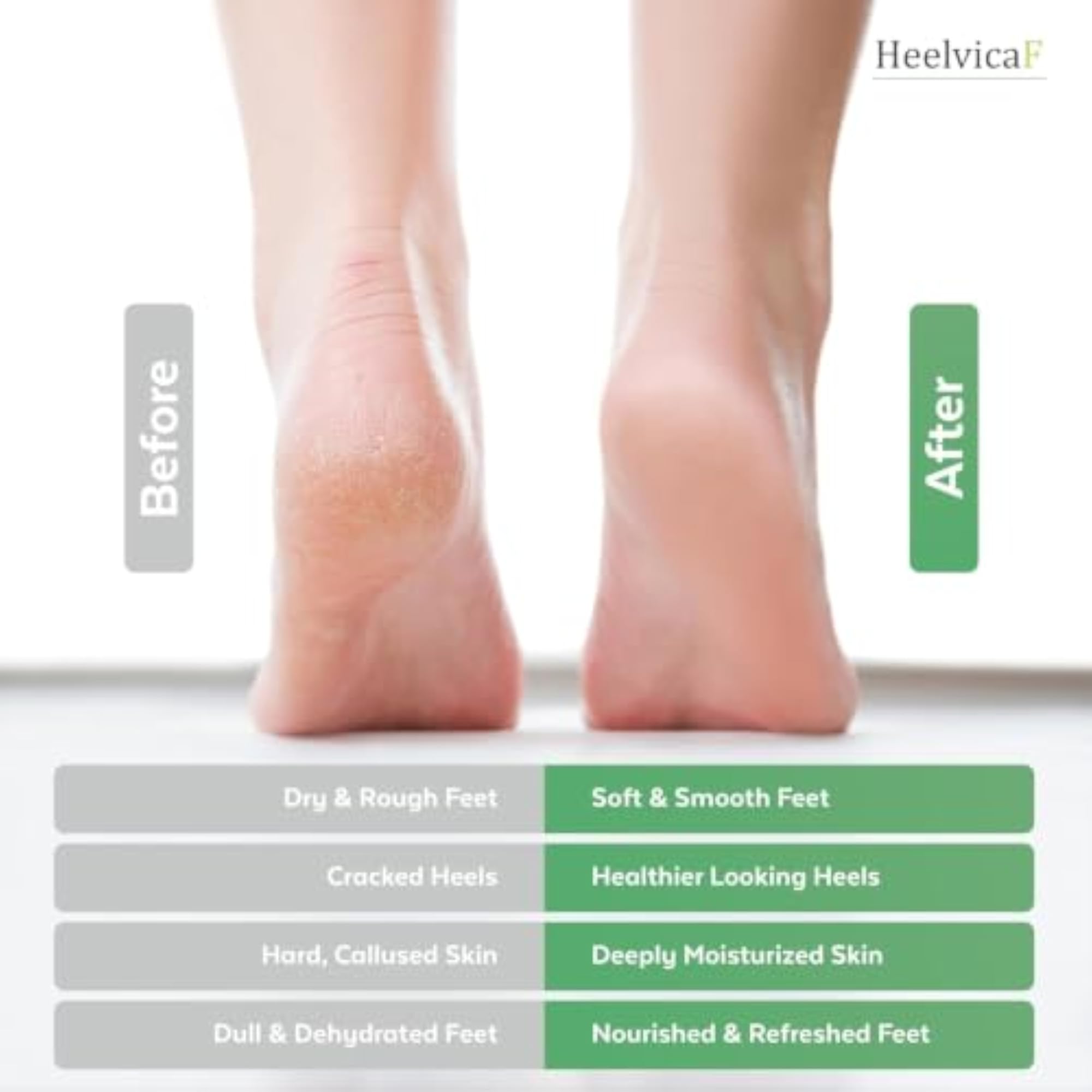 Foot Care Cream for Dry & Cracked Feet, 100g (Pack of 2)