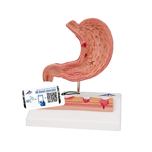 Image of 3B Scientific K17 Stomach w / Ulcers - 3B Smart Anatomy