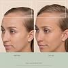 VEGAMOUR GRO+ Advanced Dermaroller | 1,200 Microneedle 0.25mm Scalp Tool | Gently Exfoliates the Scalp | Wide Head for Maximum Coverage