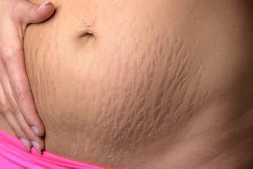 Common Pelvic Floor Problems After Twins