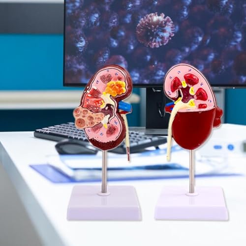 Modèle de pathologies rénales anatomique double face pour bureau médical - 3