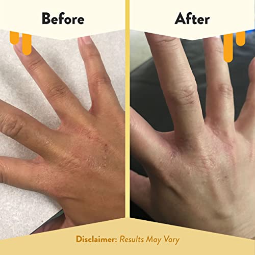 Eczema Honey Premium Witch Hazel & Aloe Spray - Facial Mist Skin Care Product - Moisturizer, Dewy Makeup Spray, Aftershave & More (8 Oz) #TOP3