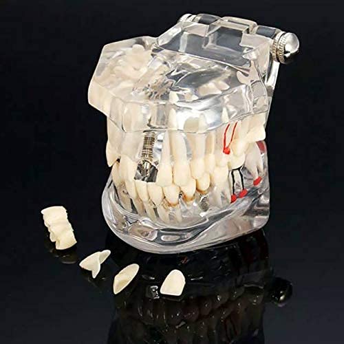 Dentist World Dental All In One Study Model, Feature - Dental implants, Crown and bridge, Implant-supported bridge, Tooth avulsion, Abfraction Root canal Caries Periapical