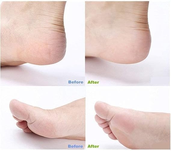 Foot Files Callus Remover, Feet Rasp for Dead Skin, Foot Care Tools, Hard Skin Corns Remover