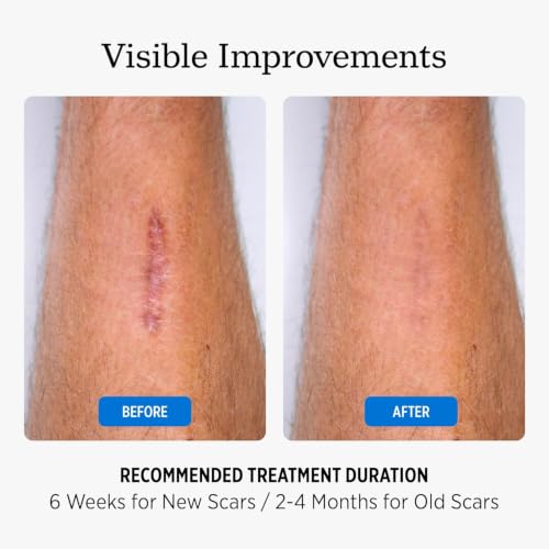 Image of Medical Grade Silicone Scar Tape Scar Sheet,Scar Strips,Scar Remover,C-Section, Surgery, Keloid, Tummy Tuck, Scar Patch (1.6 inchX 60 inch 4cmx1.5m)
