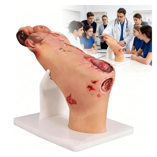 Modelo anatómico de pie diabético ideal para talleres de enfermería y curas