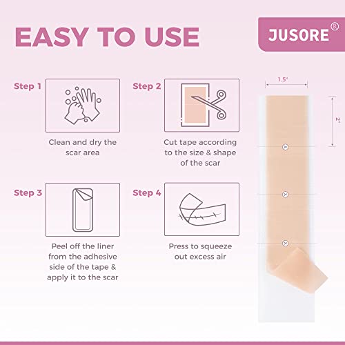 Silicone Scar Tape Scar Sheet - Upgrade Professional Medical Scar Removal Treatment, Non Irritating, Painless For C-Section, Surgical Scars, Burn, Keloid, Acne(1.6” X 60” Roll) #TOP6