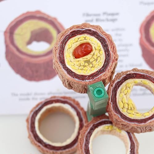Modèle d'artère avec athérosclérose AMITD pour visualiser les plaques - 5