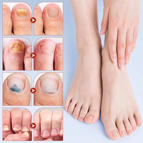 Image of Advanced Fungal Nail Patch Treatment - Powerful Antifungal Solution | Targets Nail Fungus at the Root | Easy-to-Use Patch for Toenail & Fingernail | 21 Patches (Pack of 1)