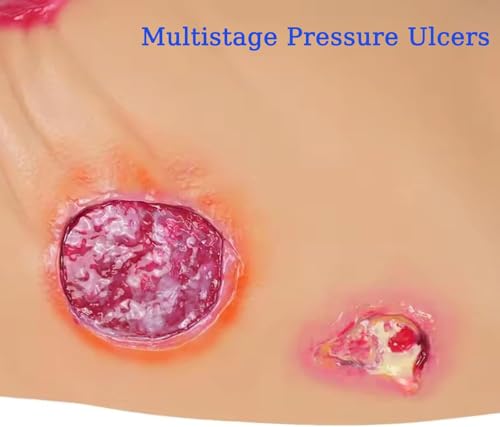 Geriatric Decubitus Ulcer Nursing Model, Bed Sore Care Simulator, Multi-Degree Ulcer Simulation, Realistic Human Body Model, for Medical Skills Training and Elderly Care Teaching