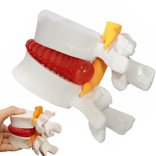 Modèle de hernie discale lombaire pour simplifier les cours d'anatomie complexes