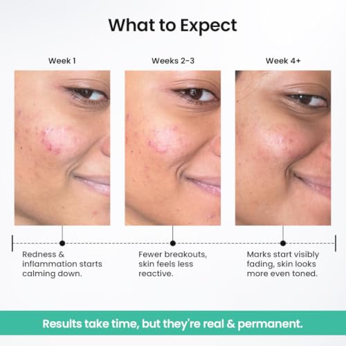 Image of The Solved Skin Spot Fade Advanced Repair Serum with 8% Solubilized Azelaic Acid & 4% Niacinamide for Post-Acne Marks, Redness, Pigmentation & Even Tone | Gentle, Lightweight Face Serum for Sensitive, Oily & Acne-Prone Skin - 30ml