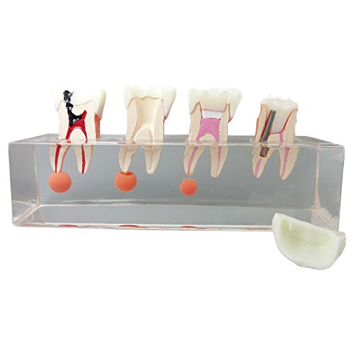 Dental Teeth Model 4-Stage Endodontic Treatment Model for Studying and Teaching …