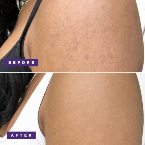 Image of DERMAdoctor KP Bump Eraser Body Scrub with 10% AHAs + PHAs for Keratosis Pilaris, Dry, Rough, and Bumpy Skin, Dermatologist Formulated Exfoliating Body Scrub with Glycolic and Lactic acids - 8 Fl oz