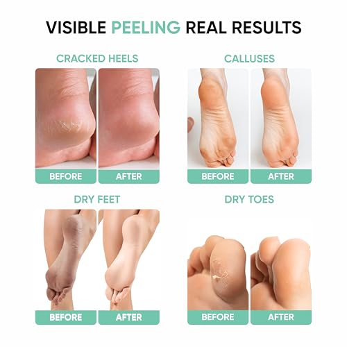 Image of Masofta Exfoliating Foot Peeling Mask for Dry, Cracked Heels & Calluses With Glycolic, Lactic & Salicylic Acid | Peels Dead Skin in Days | Baby Soft Feet Treatment for Men & Women (1 Pair)