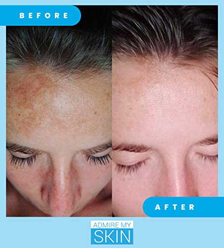 Admire My Skin Dark Spot Corrector Remover For Face - Brightening Discoloration Correcting Serum - Melasma Treatment Cream With Synovea, Kojic Acid, Vitamin C, Salicylic Acid, Lactic Acid Serum #TOP4