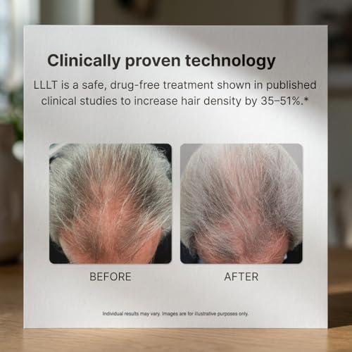 Image of Alpha Hair Growth Laser Cap (136 Lasers) FDA Cleared Laser Hair Growth Device for Men & Women, SMT Laser Technology, Continuous Wave Output, 6-Min Daily Treatment, Drug-Free Hair Regrowth Cap
