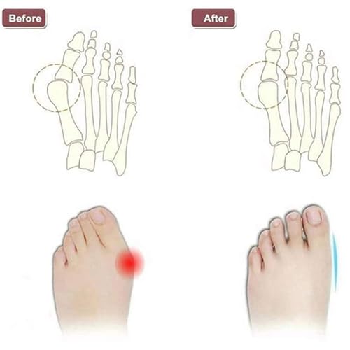 Summer Toe Corrector Sandal, Men Soft Cross Strap Bunion Splints Sandals with Adjustable Metal Buckle Strap, Open Toe Plantar Fasciitis Beach Flip Flops, for Valgus Big Bone Orthopedic(White,7)2