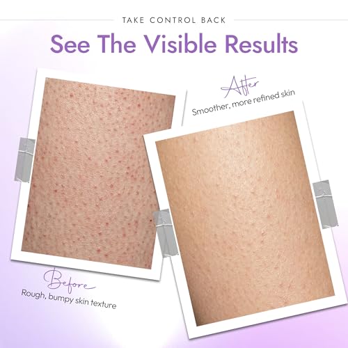 Image of DERMAdoctor KP Bump Eraser Body Scrub with 10% AHAs + PHAs for Keratosis Pilaris, Dry, Rough, and Bumpy Skin, Dermatologist Formulated Exfoliating Body Scrub with Glycolic and Lactic acids - 8 Fl oz