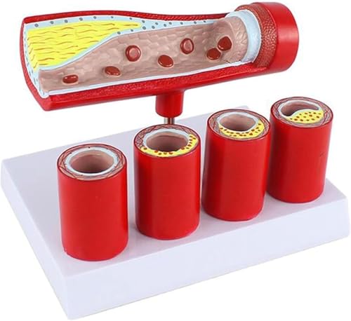 Modèle d'anatomie de thrombose et sclérose coronaire en 4 phases
