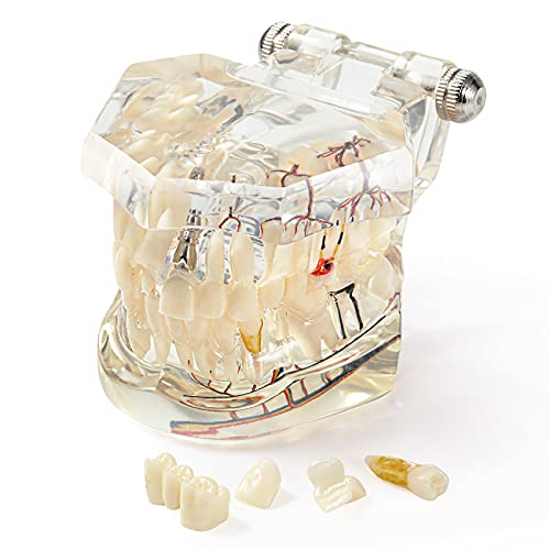 Annhua Neural Repair Dental Implant Disease Teeth Model Transparent Pathological Model with Removable Teeth, Dentist Standard Pathological Teaching Model for Patient Education, Dental Office
