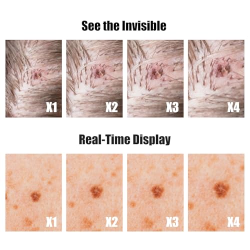 Image of Handheld Dermatoscope Skin Analyzer Machine, Wireless Portable Digital Microscope with 1080P IPS Screen 8 LEDs, 500X Magnifier, for Scalp /Hair Trichomes