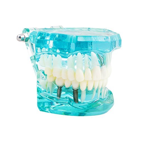 Vinmax Dental Teeth Model,Transparent Dental Implant Disease Teeth Model Dentist Standard Pathological Removable Tooth Teaching Tools For Student thumb #2