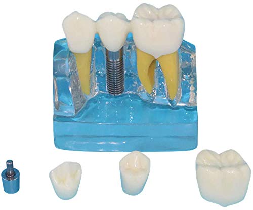 Modèle De La Dent Humaine, Modèle Dentaire Transparent Personnes Modèle Oral, Implant Dentaire Utilisé pour La Recherche dans Les Domaines De La Communication Ou L'Affichage Patients