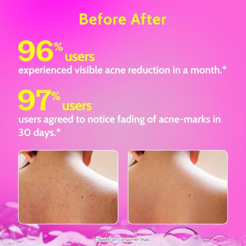 Chemist at Play Store Chemist at Play 1% Salicylic Acid Acne Body - Image 4