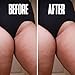 Prevent Ingrown Hairs and Razor Bumps with BHA & AHA Pads - Ingrown Hair Serum for Razor Burns - PFB Razor Bump Stopper Topicals Skin Care, Ingrown Hair Treatment for Bikini Area and Razor Bumps