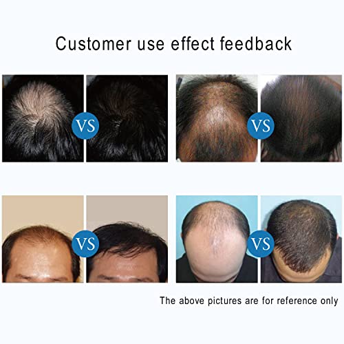 FDA-Cleared Laser Hair Growth Helmet for Men and Women with Red Light Therapy