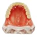 Dentalmall Dental Upper Implants Model Overdenture with 4 Superior Teeth Demo Transparent Vision for Education and Study Model Tool M6001 C