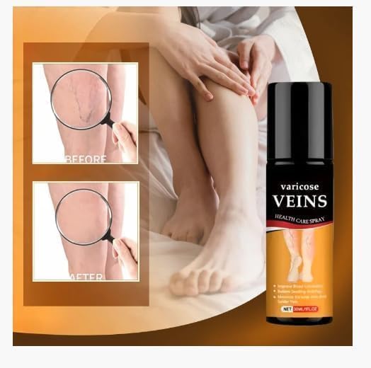 Image of Varicose Veins Spray - Natural Herbal Formula for Fast Relief | Reduces Swelling, Relieves Pain & Promotes Blood Circulation | Easy-to-Use Spray for Legs, Ankles & Feet (PACK OF 2, 60 ML)