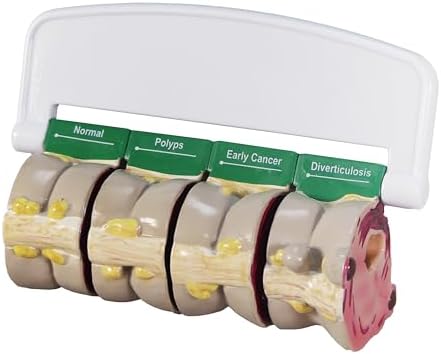 GPI Anatomicals 4-Piece Colon Model, Replica with Pathologies
