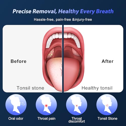 Image of Upgraded Electric Tonsil Stone Remover - High-Precision & Painless Cleaning, Food-Grade Material, 6 Suction Levels | Tonsil Stone Removal Kit with LED Light, Oral Protection & 11 Attachments
